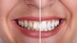 Best Whitening Toothpaste